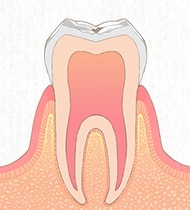 虫歯初期 C0段階イメージ